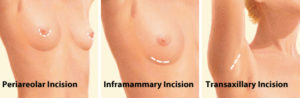 picture of breast augmentation incision